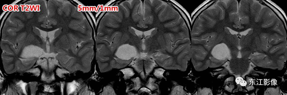 头颅mri扫描影像哪里找,头颅影像mra详细解说