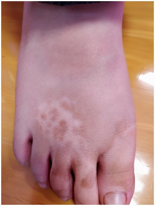 白癜风是个什么,白癜风到底是什么