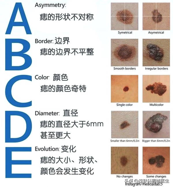 皮肤科什么肿瘤恶性高,皮肤恶性黑色素瘤是癌吗