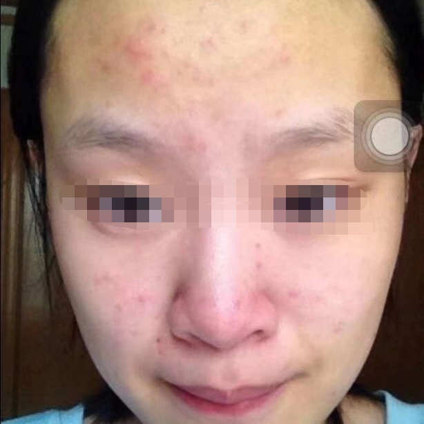 热带小黑虫怎么预防叮咬,弥勒小黑虫叮了起水泡