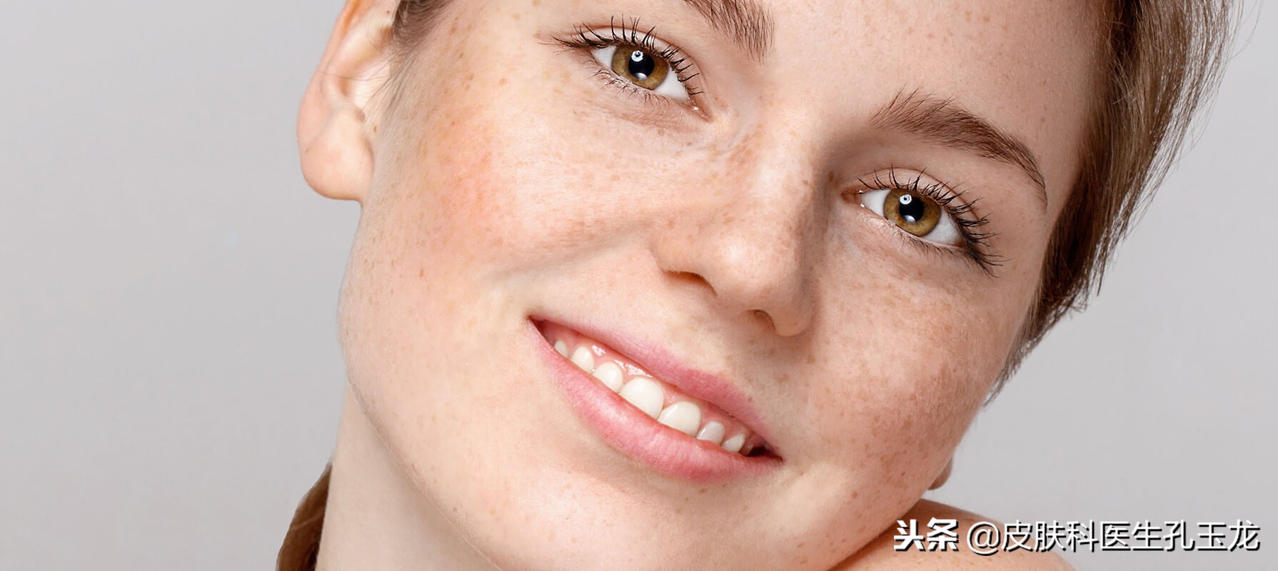 皮肤科常见疾病系列,雀斑属于什么皮肤病