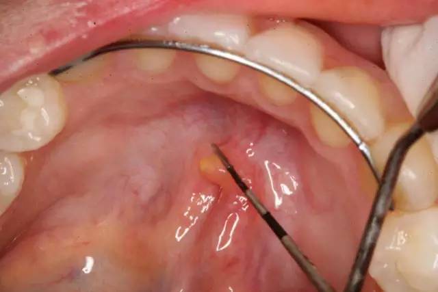 唾液腺结石长在口腔里,口腔唾液结石快速解决方法