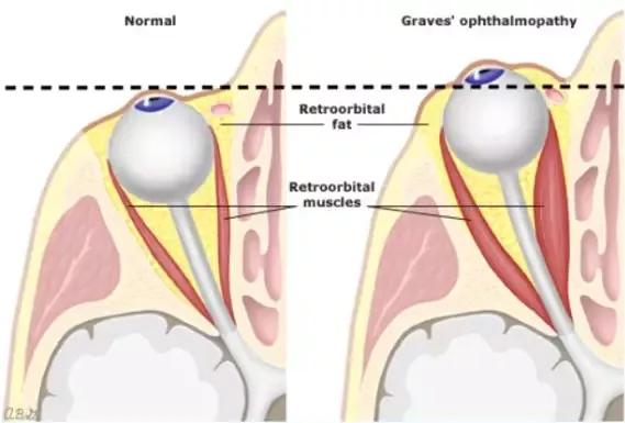 甲亢性眼突婴儿,8岁的小孩得了甲亢能自愈吗