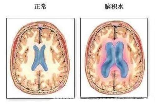 老年痴呆患者突然不糊涂了,老年人糊涂了能治好吗