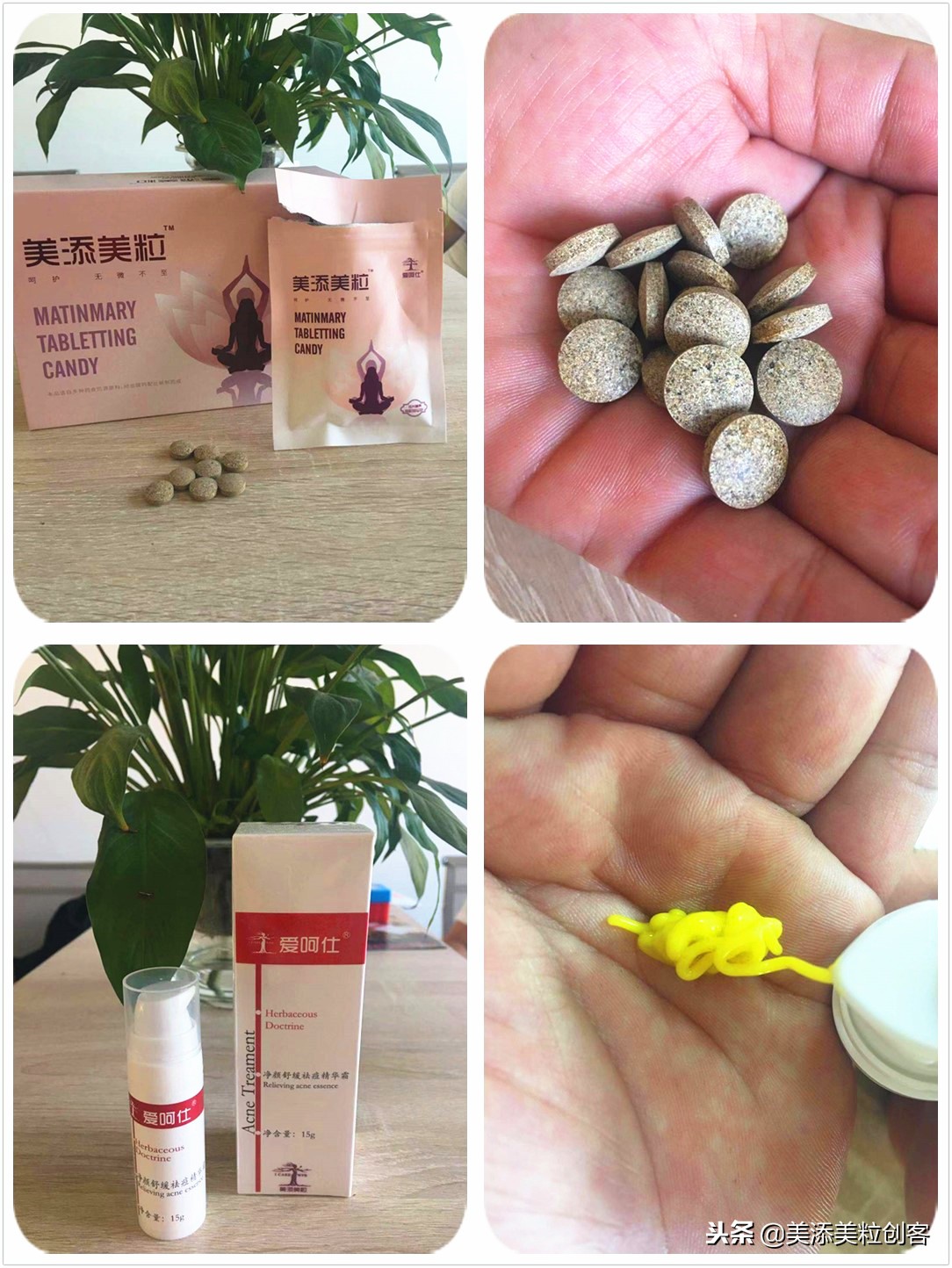 肠胃湿热症导致的闭口开口粉刺痘，这样对症而治少走很多弯路！