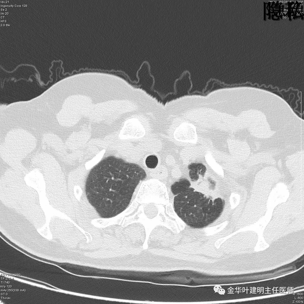 左肺下叶恶性病变,左肺上叶和下叶都有血管畸形