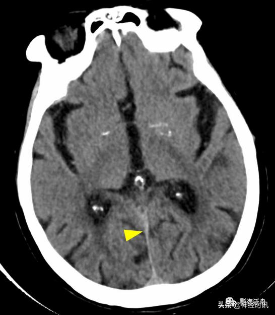 蛛血的临床表现,蛛血ct表现