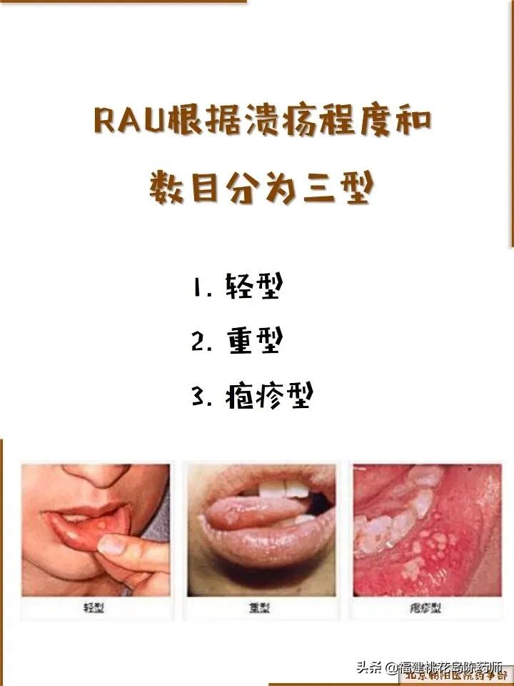 复发性口腔溃疡的原因及治疗方法,顽固性口腔溃疡有什么好药