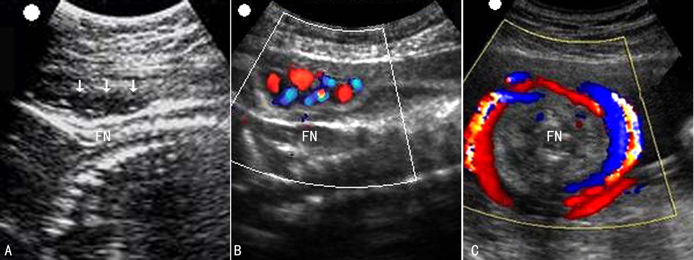 脐带过长超声诊断,脐带过长或过短能检查出来吗