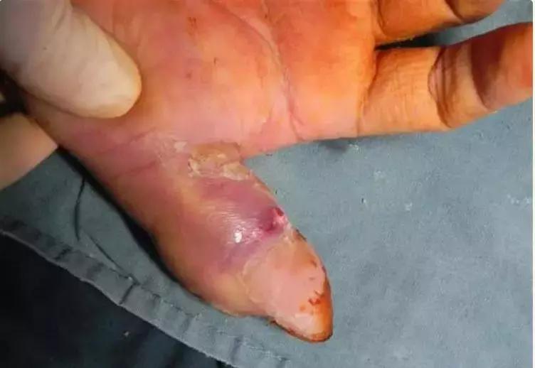 广东一位市民和小偷打斗,手指被咬了一口,竟然要截肢!