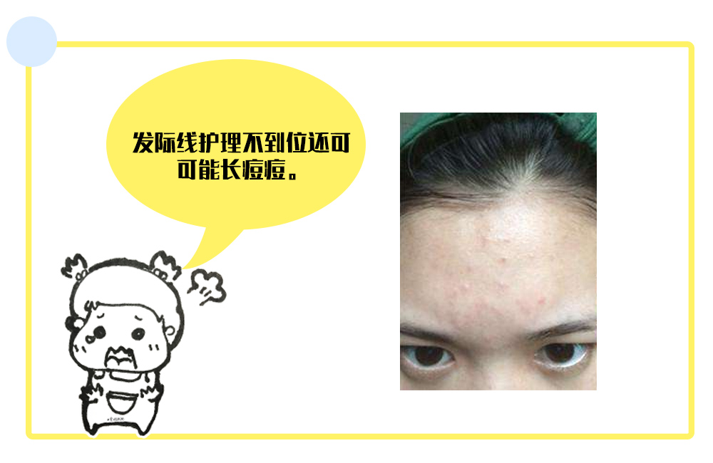 扎头发发际线高怎样修刘海,扎头发简单好看保护发际线