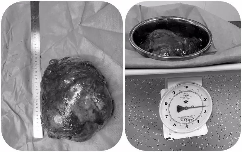 漳州第三医院:一男子高烧39.8℃被紧急送医,检查后发现肚里居然藏着“定时*弹炸**”