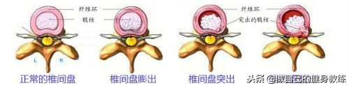 你有椎间盘突出（腰脱）的问题吗？健身3式轻松解决！