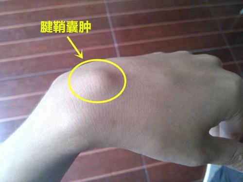 骨科可以治腱鞘囊肿吗,脚腱鞘囊肿最快的恢复办法