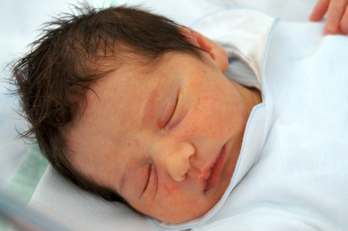 宝宝湿疹治疗过程四大禁忌,宝宝湿疹不要慌治疗湿疹有妙招