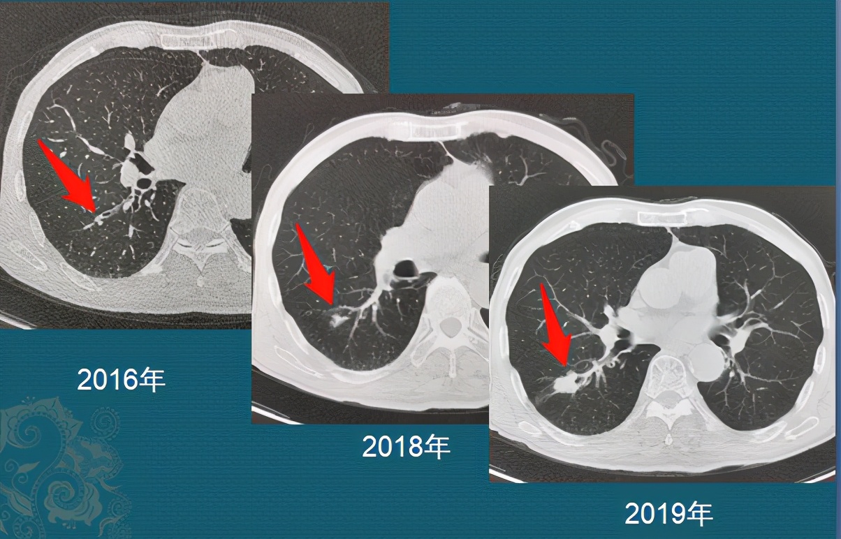 怎样确定肺鳞癌生长速度过快,肺鳞癌肿瘤生长速度