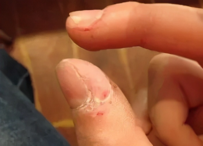 抠手、啃指甲停不下来，这些习惯要注意