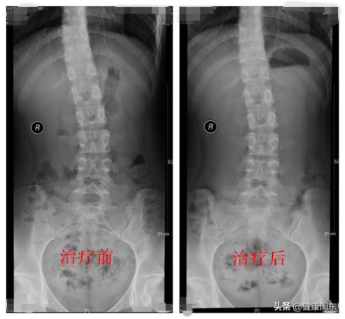 轻度脊柱侧弯需要矫正吗,脊柱轻度侧弯需要治疗吗