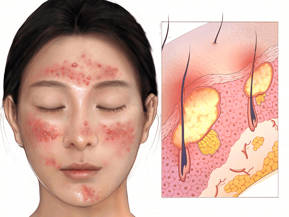 痘痘、闭口反反复复?搞定痘痘,这6种药不能少