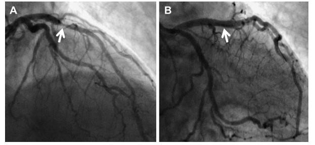 急性广泛前壁心肌梗死必须支架吗,急性非st段心肌梗死一定要支架吗