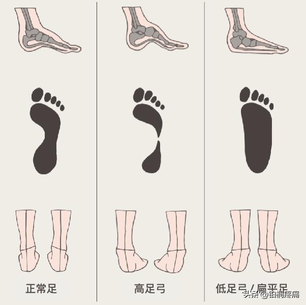 习惯性崴脚康复训练推荐动作,踝关节力量差容易崴脚吗