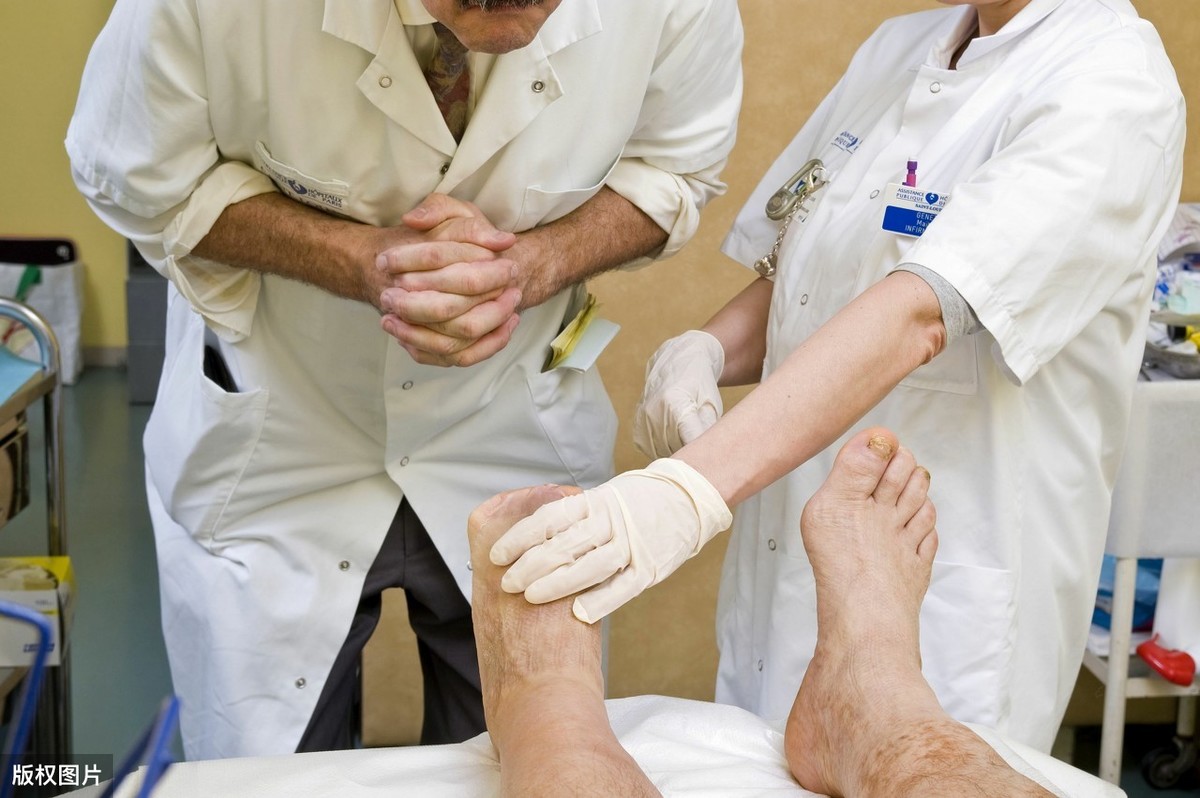 糖尿病足脚趾发黑溃烂能活多久,糖尿病足干裂可以活多久