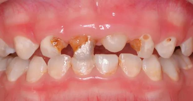 用奶瓶喝水总是呛到怎么办,孩子长期用奶瓶喝水嘴会变形吗