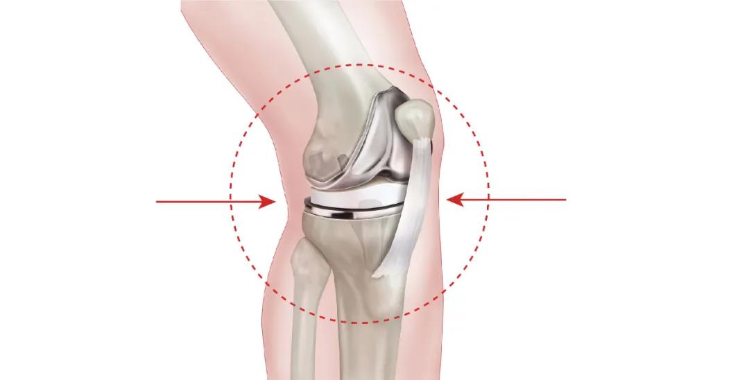 单髁膝关节置换手术后康复,膝关节置换术前注意事项主任讲解
