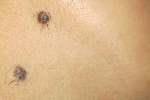 下巴黑痣上长毛预示什么,痣上长毛可以剪掉么