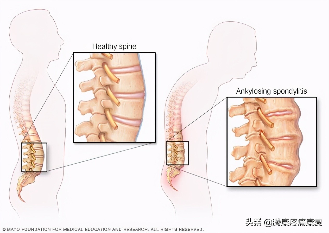 强直性脊柱炎有什么预防的方法吗,强直性脊柱炎预防与锻炼方法