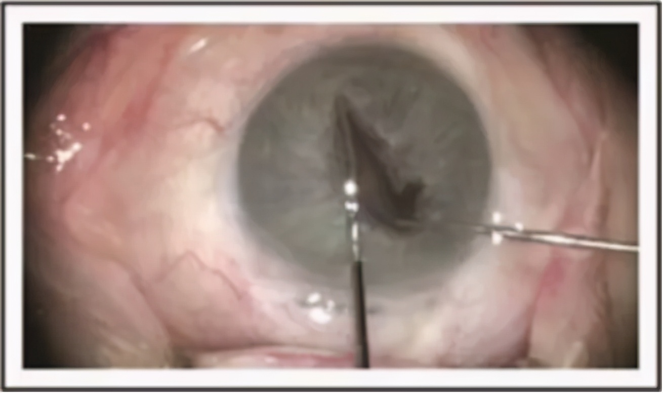 小瞳孔白内障的治疗,瞳孔小能做白内障手术吗