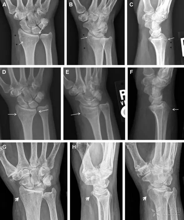 常见的八种骨折,容易漏诊的肩关节骨折