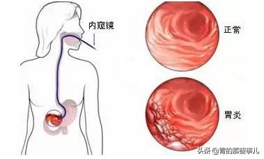 胃炎快速治疗的方法是什么,儿童慢性胃炎怎么治疗恢复得快