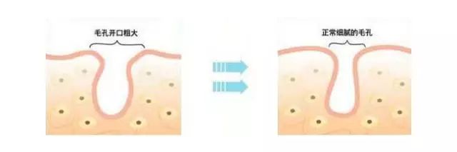 毛孔粗大皮肤暗黄该怎么改善肤质,毛孔粗大肤色暗沉应该怎么改善