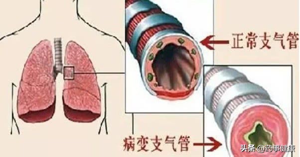 慢性支气管炎和急性支气管炎区别,慢性支气管炎与急性支气管炎区别