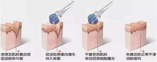 鍋氱編瀹瑰幓姣涘瓟绮夊埡榛戝ご鐥涘悧,鍋氱編瀹圭鐥樺潙