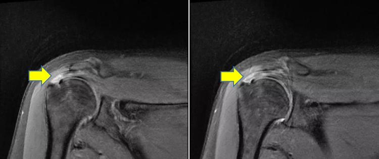 潍坊哪个医院看肩周炎比较好,潍坊中医院颈肩腰腿疼专家