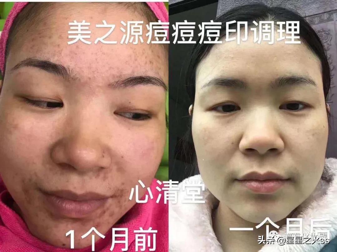 心清堂护肤品祛痘修复,兰树心清堂祛痘效果