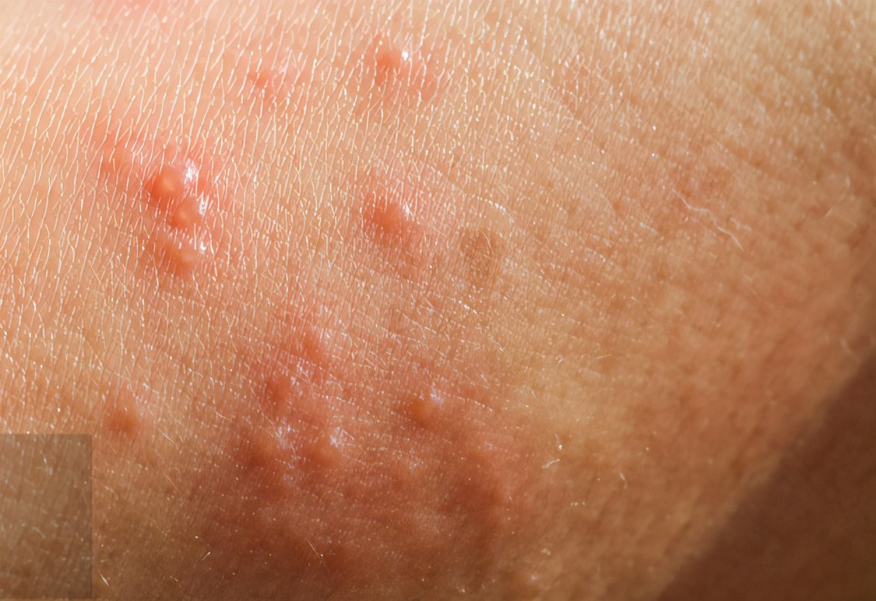 湿疹怎么治疗最有效视频,深度湿疹怎么治