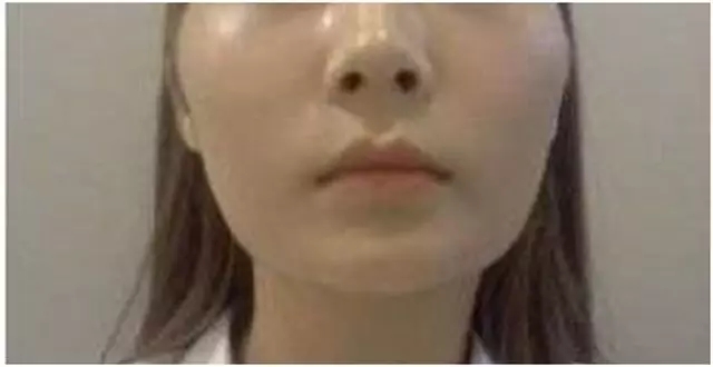 打瘦脸针后如何避免咬肌反弹,肉毒素瘦脸针怎么样避免碰到神经