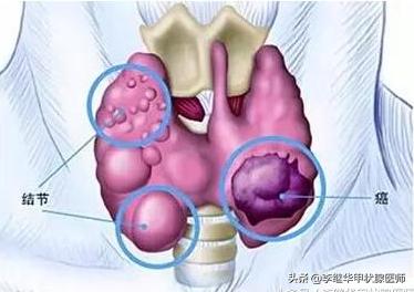 桥本甲状腺炎看中医好还是西医好,甲状腺结节最佳中医治疗方法