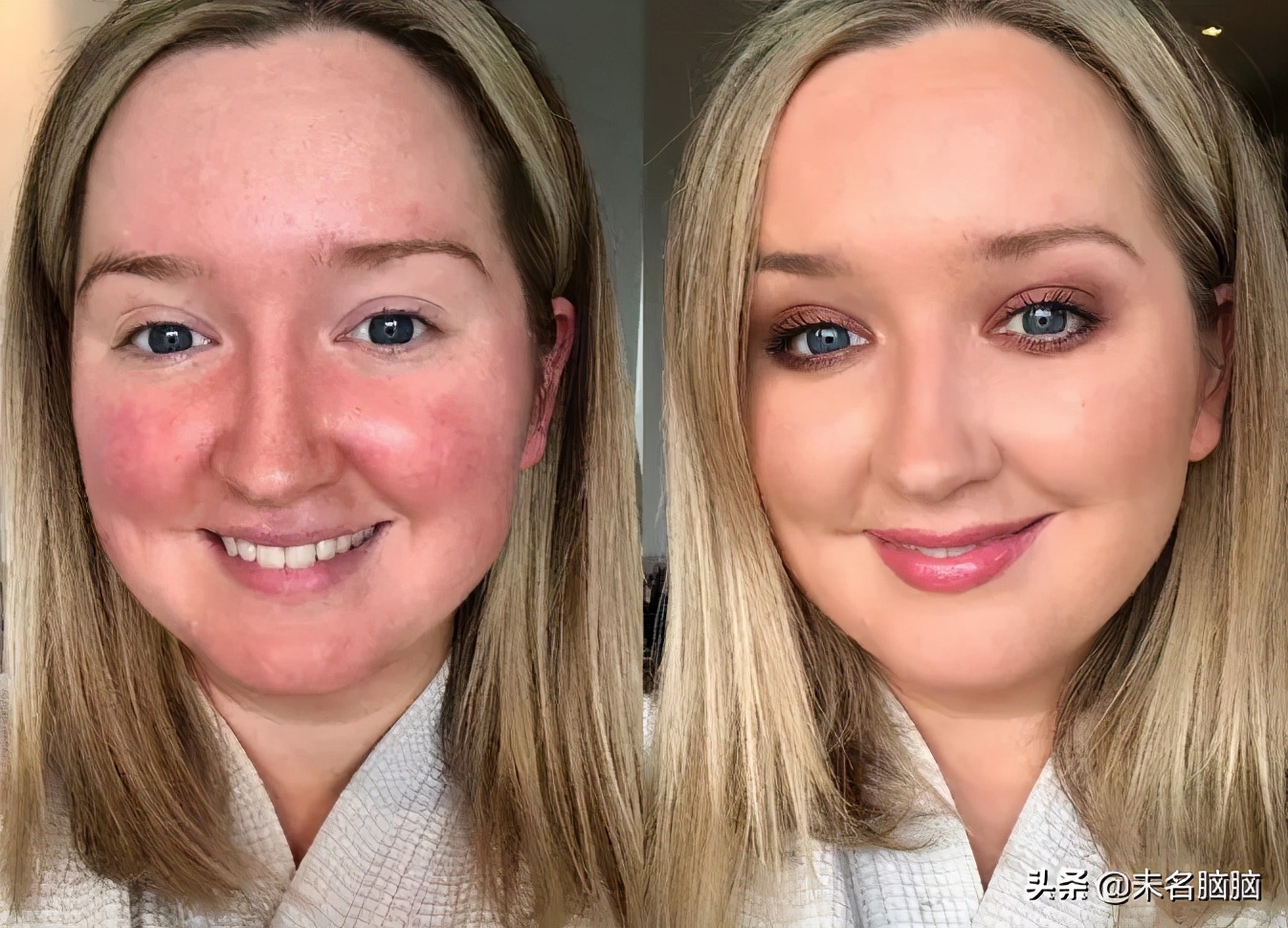 哪些是阿尔茨海默症的风险因素,老年性痴呆阿尔茨海默病病例