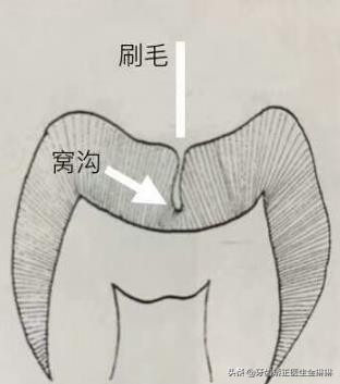 牙齿窝沟有黑线能窝沟封闭吗,窝沟封闭小知识