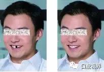 门牙撞了怎么办,门牙意外损坏怎么办