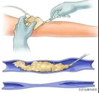 蚯蚓腿微创手术多少钱,蚯蚓腿手术费用多少