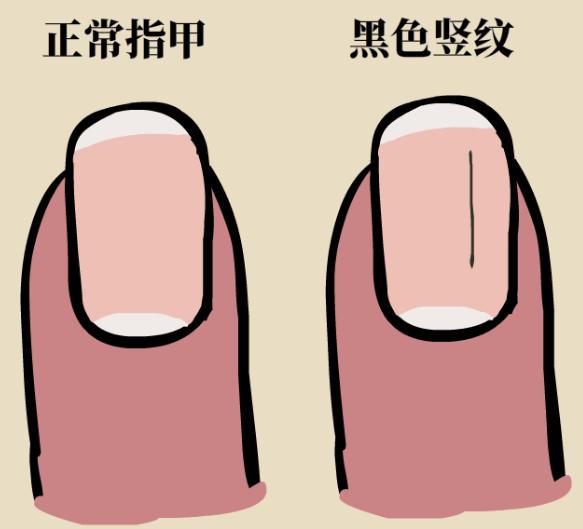 指甲上有凹痕是什么原因,指甲出现甲凹点是什么原因