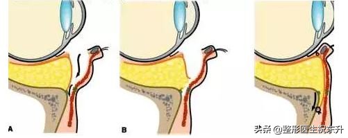 为什么年龄大了祛眼袋要做眶隔脂肪释放呢？