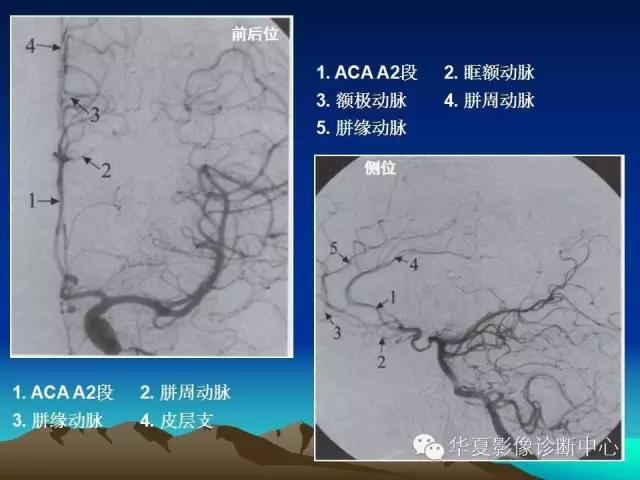 小脑血管解剖分段,脑血管影像解剖讲解