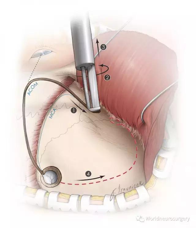 翼点入路技巧图解,翼点入路的开颅要点