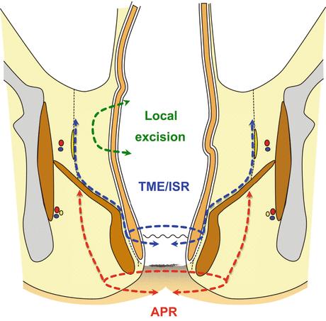 直肠癌“保肛”，你必须知道的知识